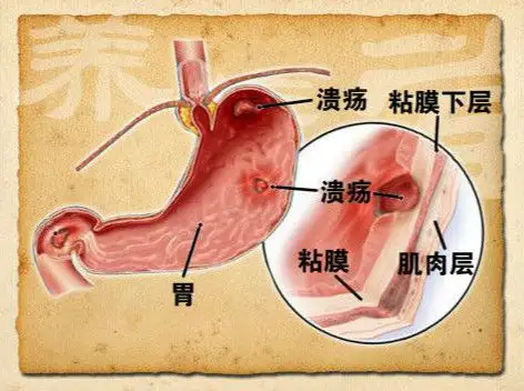 胃溃疡症状